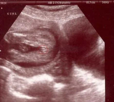 男胎儿小鸡b超显示图：超准的b超图看生男生女