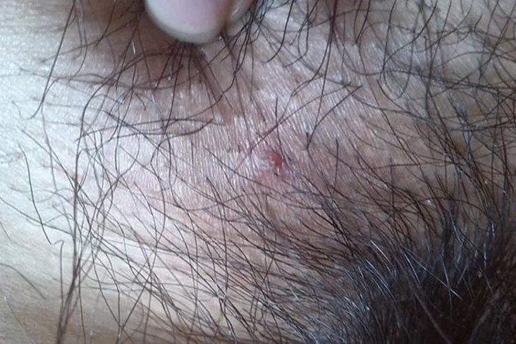 外阴毛囊炎图片