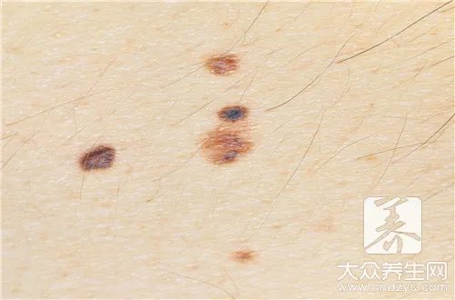 脸上七星痣预示什么