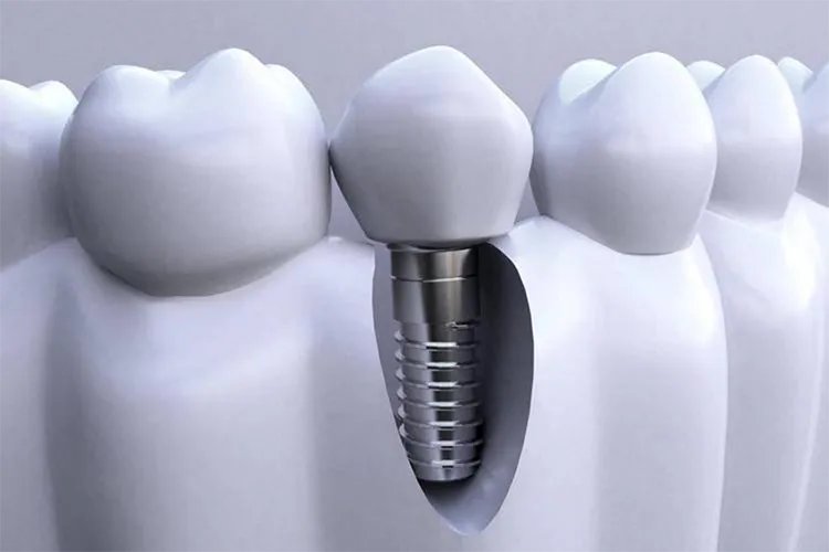 什么样的假牙最好