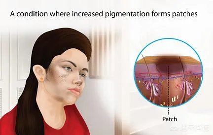 有了黄褐斑，该如何淡化不反弹？