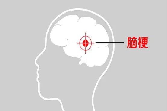 脑梗前兆是什么