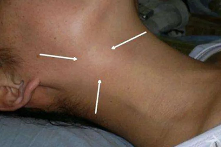 扁桃体炎颈部肿块图片