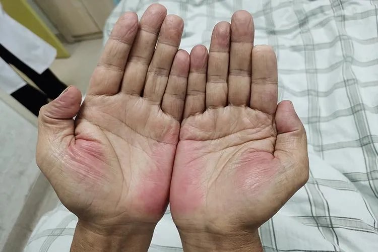 肝癌早期图片高清图片大全