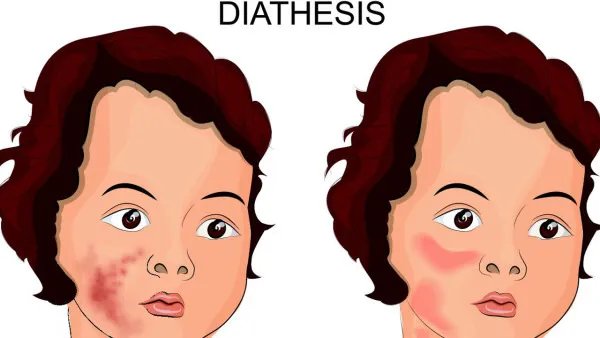 暗疮和痤疮有什么区别