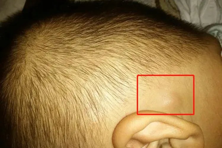 儿童淋巴结肿大图片