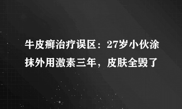 牛皮癣治疗误区：27岁小伙涂抹外用激素三年，皮肤全毁了