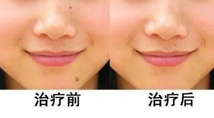 激光去痣多少钱一颗