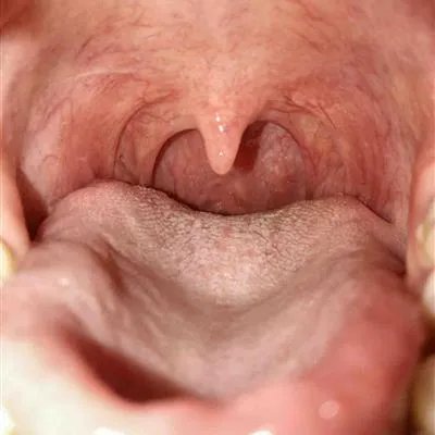 甲状腺结节怎么治疗比较好