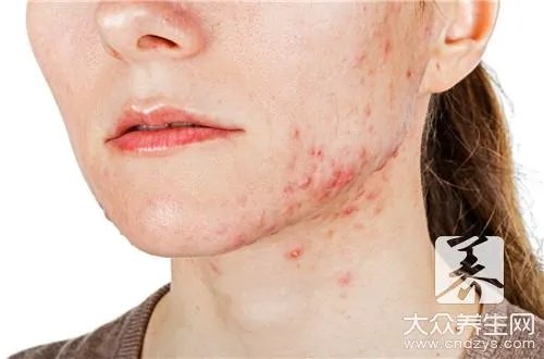 姜黄消痤搽剂去痘印的效果怎么样？