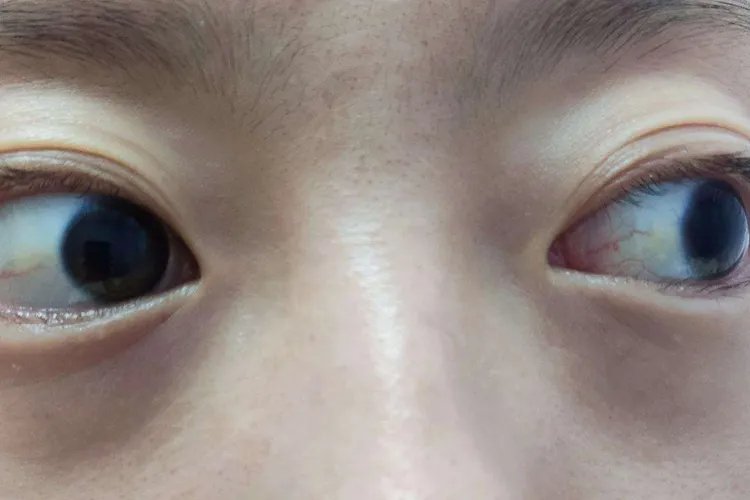 肝癌早期图片高清图片大全