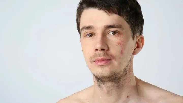 成人红胎记检查的费用是多少呢