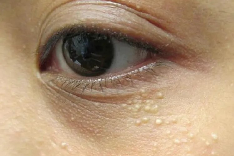 脂肪粒是什么样的图片