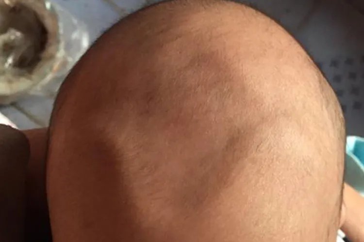 囟门怎样才算凹陷图片