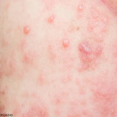 过敏性药疹留下黑色素怎么消除