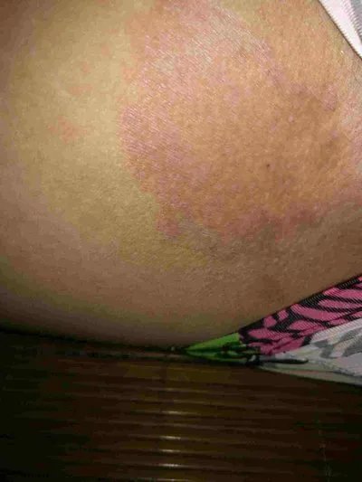 吃芒果过敏有什么症状?