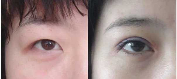 做韩式双眼皮多少钱