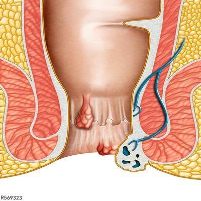 教你如何自测痔疮 从三个症状自测痔疮