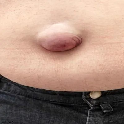 脐疝是怎么回事 从三个原因认识脐疝