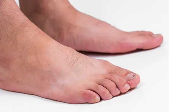 脚底脱皮是什么原因