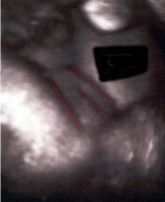 男胎儿小鸡b超显示图：超准的b超图看生男生女