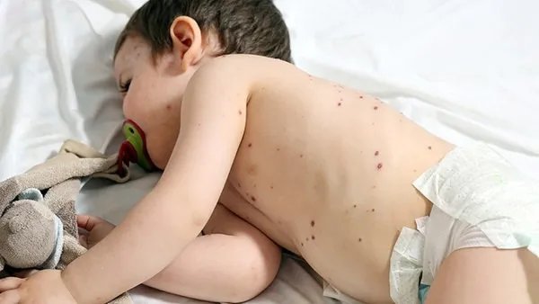 手足口病有什么症状