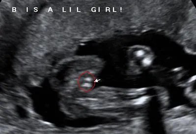 男胎儿小鸡b超显示图：超准的b超图看生男生女