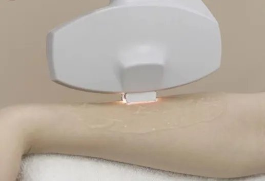 永久性光子脱毛治疗