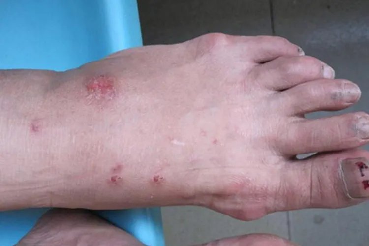 湿疹症状照片