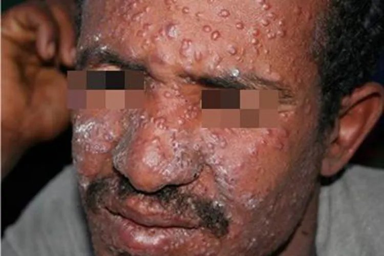 利什曼病面部小疙瘩图片