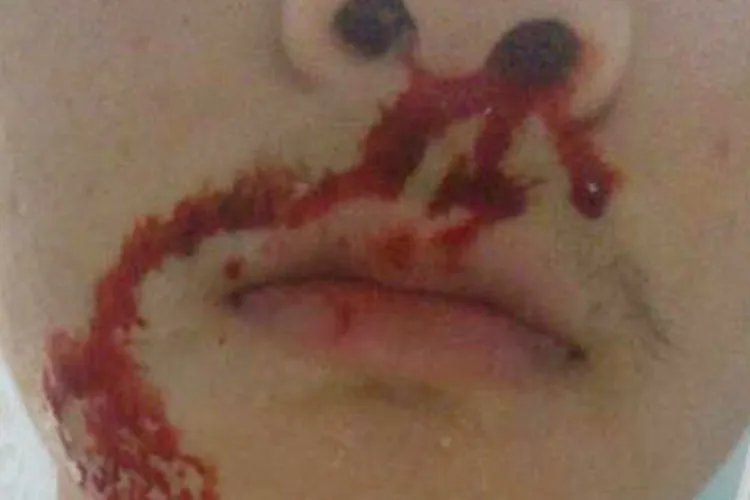 肝癌早期图片高清图片大全