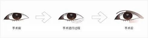 开眼角术前后需要注意的问题有什么？
