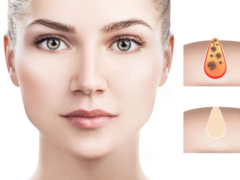 芝麻毛孔怎么缩小