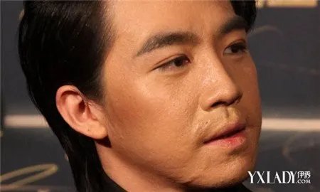 俞灏明疤痕明显烧伤前后对比素颜疤痕吓人