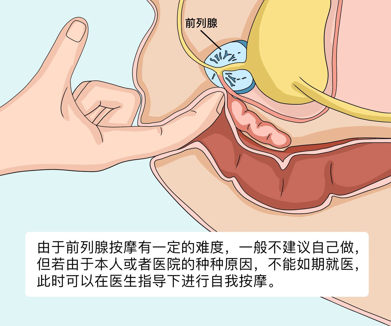 自己可以做前列腺按摩吗