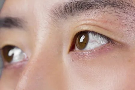 红眼病怎么传染