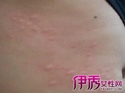 小儿荨麻疹的症状