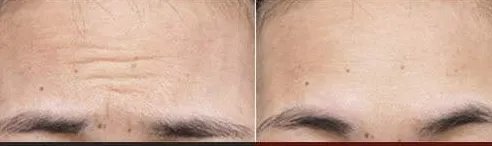 去抬头纹会肿吗