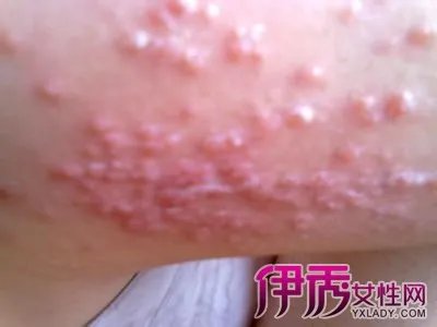 小儿荨麻疹的症状