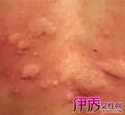 小儿荨麻疹的症状