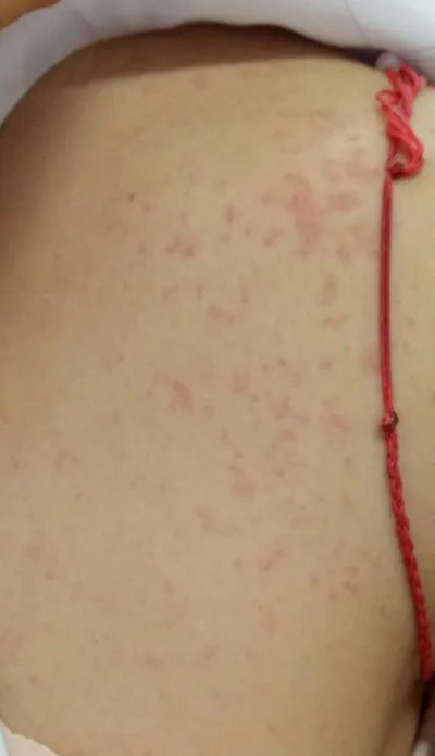 吃芒果过敏有什么症状?