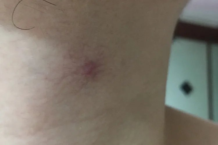 肝癌早期图片高清图片大全