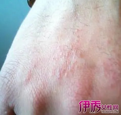 夏天手上起小水泡的原因有哪些？