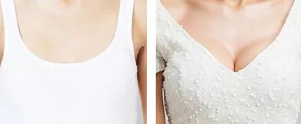 妙桃丰胸一般多少钱